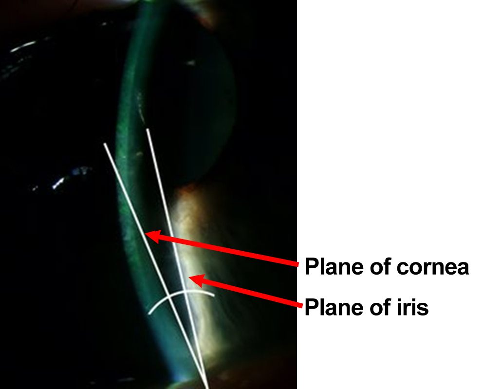 photo angle between the plane of the cornea and the iris